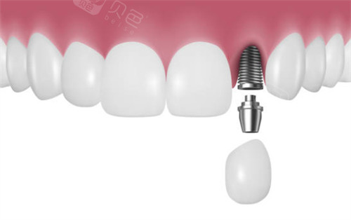 韓國柯威爾種植體有幾種？五大柯威爾種植體型號及其特點