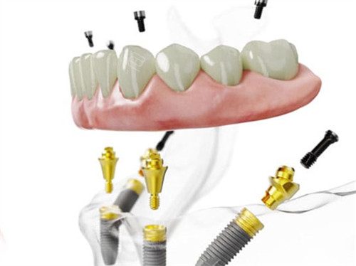 手术刀是什么材料日本叫停种植牙真相曝光！不是技术不行｜非认证机构乱象+材料隐患是关键_https://www.jmylbn.com_新闻资讯_第1张