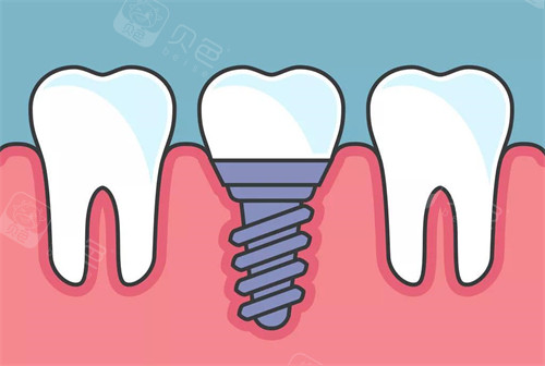 手术刀是什么材料日本叫停种植牙真相曝光！不是技术不行｜非认证机构乱象+材料隐患是关键_https://www.jmylbn.com_新闻资讯_第6张
