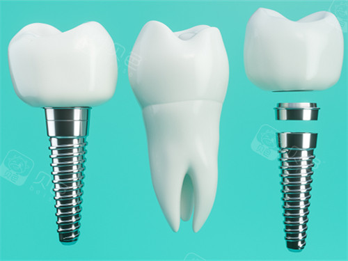 手术刀是什么材料日本叫停种植牙真相曝光！不是技术不行｜非认证机构乱象+材料隐患是关键_https://www.jmylbn.com_新闻资讯_第5张