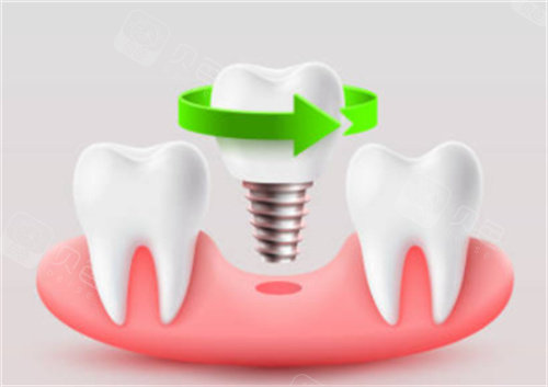手术刀是什么材料日本叫停种植牙真相曝光！不是技术不行｜非认证机构乱象+材料隐患是关键_https://www.jmylbn.com_新闻资讯_第2张