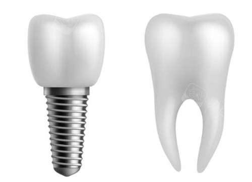 种植牙对比正常牙好在哪