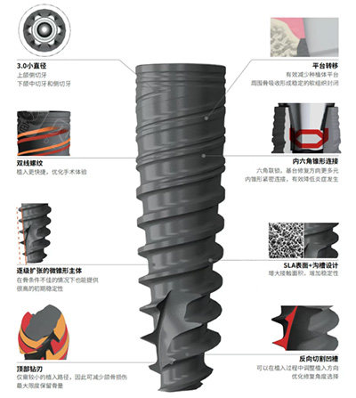 百齿泰泰锆3.0种植牙怎么样