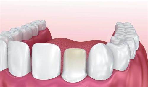 揭秘吉尔巴赫全瓷牙：高强度耐磨、美观自然，口腔修复的优质之选！