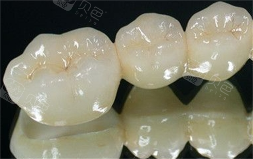 厦门全瓷牙做一颗价格是多少钱？爱尔创1500元起，威兰德2200元起！