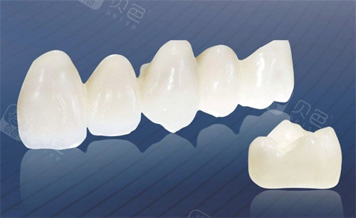 泽康全瓷冠和LAVA全瓷冠哪个好？从强度/美观/价格教你精细选择