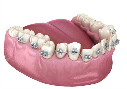 正畸挂皮筋的钩子掉了要紧吗?需及时复诊,别拖延!