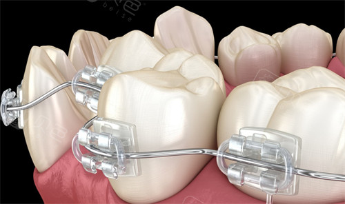 正畸挂皮筋的钩子掉了要紧吗?需及时复诊,别拖延!