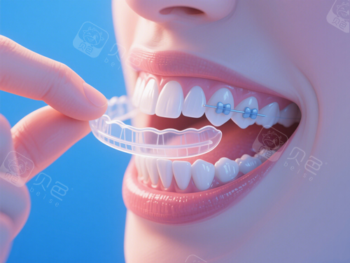 隐形牙套价格一般是多少钱价格表:国产牙套12800+进口29800+