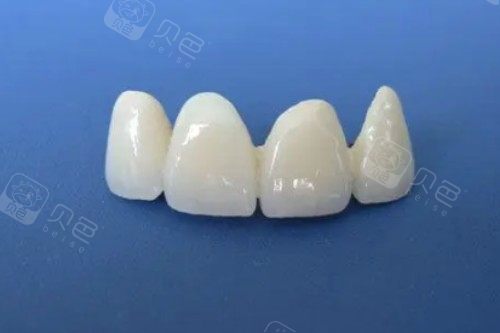 全瓷牙模型展示图