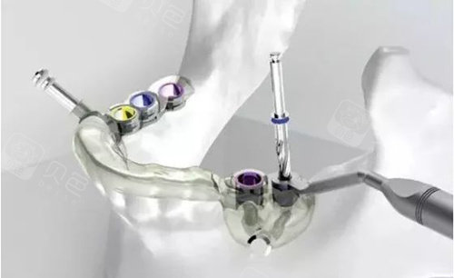 种植牙导板在手术中的应用