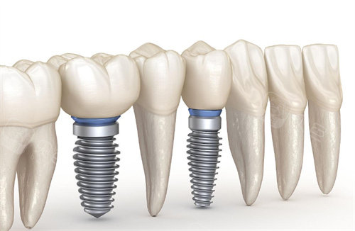 种植牙动画图片展示