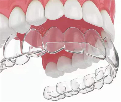 隐形矫正牙齿示意图