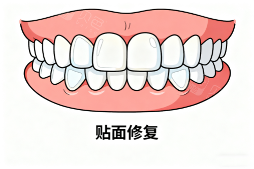 牙齿贴面修复卡通图