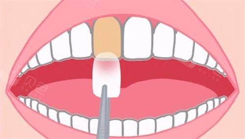 牙齿贴片和全瓷牙哪个好？从硬度价格，结合牙齿条件解析让你不浪费钱！