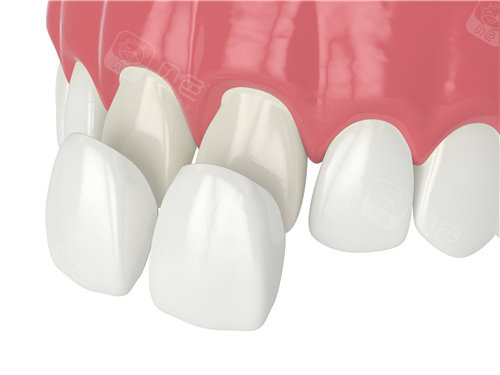 牙齿贴面安装