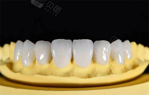 全瓷牙模拟展示