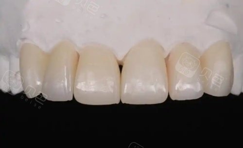 爱迪特全瓷牙示意图
