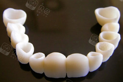 半口全瓷牙冠示意图