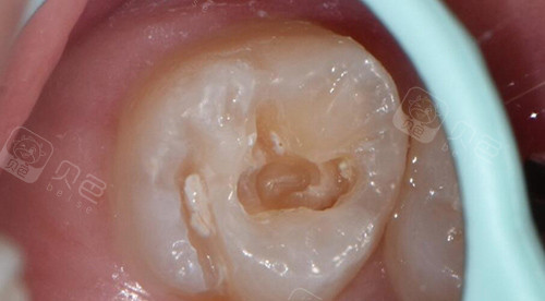 补牙改善图过程