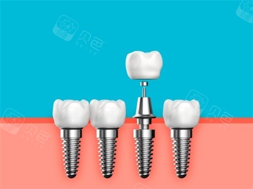 种植牙植体基台和牙冠漫画图