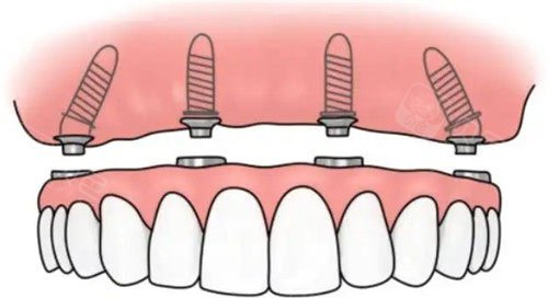 韩国登腾种植牙超值得做！我亲测体验感超棒，不建议做的说法不靠谱