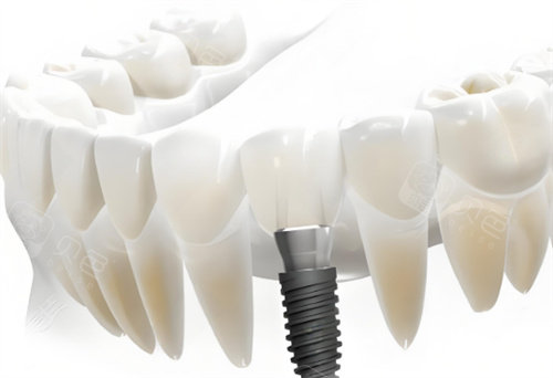 韩国登腾种植牙超值得做！我亲测体验感超棒，不建议做的说法不靠谱