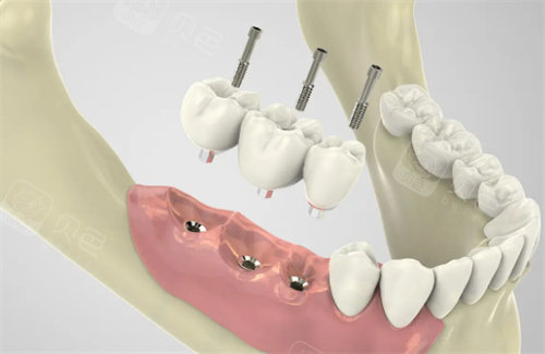 种植牙过程展示图片