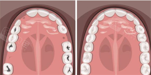 牙齿缺失补牙示意图