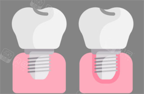 种植牙前后对比图