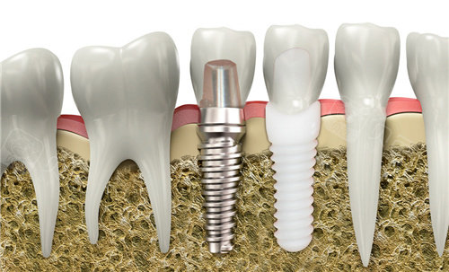 韩国桀诺GENO种植牙3500元不贵！材质靠谱+种植结果好