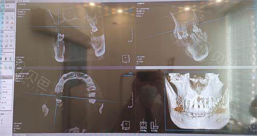 珠海仁爱口腔牙齿拍片