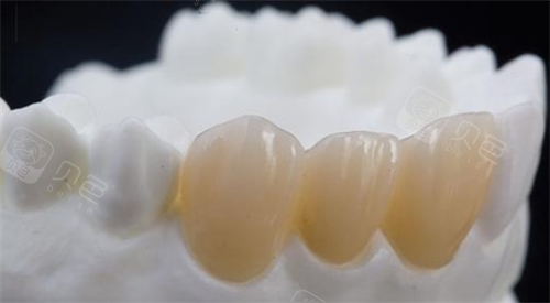 前牙全瓷冠展示