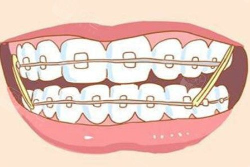 牙齿矫正卡通图片展示