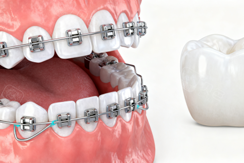 牙齿矫正卡通展示图