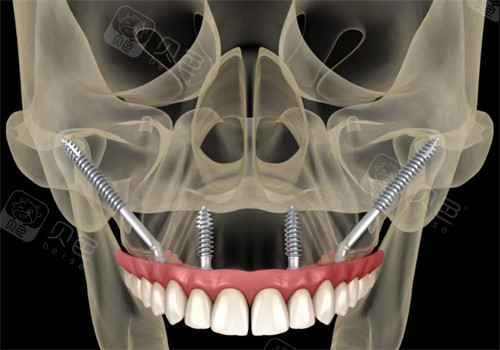 穿颧穿翼技术动画示意图