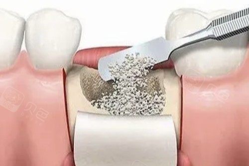 种植牙植骨图片展示