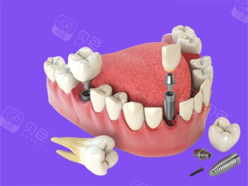 多颗种植牙漫画图