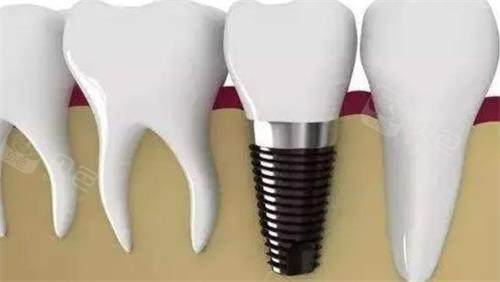 种植牙后效果图