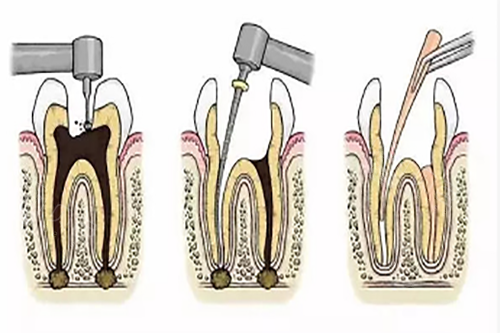 口腔高速手机怎么修社畜看牙记：在德伦口腔看牙，根管治疗全程温柔沟通，我居然舒服到睡着_https://www.jmylbn.com_新闻资讯_第4张