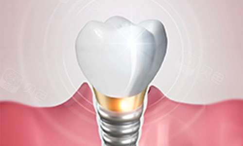 卡瓦口腔怎么购买德国卡瓦种植牙多少钱一颗？6000元起，优缺点／真实用户体验一览_https://www.jmylbn.com_新闻资讯_第1张