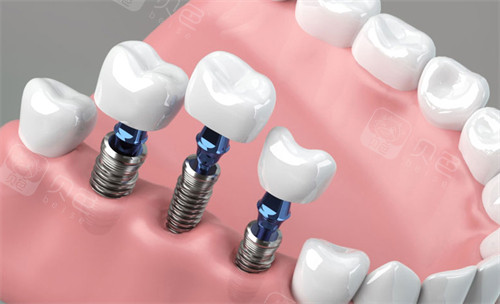 卡瓦口腔怎么购买德国卡瓦种植牙多少钱一颗？6000元起，优缺点／真实用户体验一览_https://www.jmylbn.com_新闻资讯_第2张