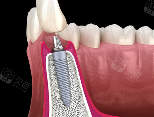 卡瓦口腔怎么购买德国卡瓦种植牙多少钱一颗？6000元起，优缺点／真实用户体验一览_https://www.jmylbn.com_新闻资讯_第5张