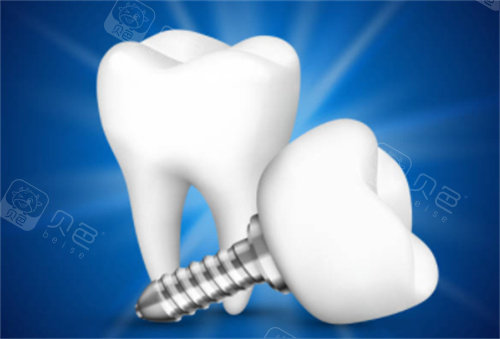 卡瓦口腔怎么购买德国卡瓦种植牙多少钱一颗？6000元起，优缺点／真实用户体验一览_https://www.jmylbn.com_新闻资讯_第6张