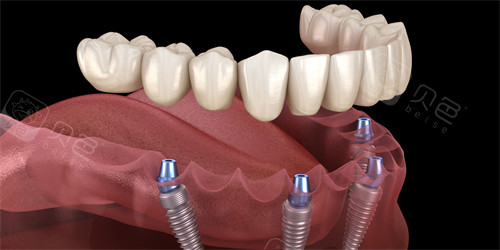 半口种植牙图示