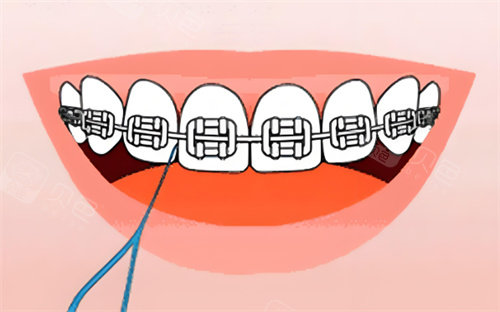 金属牙齿矫正卡通图片