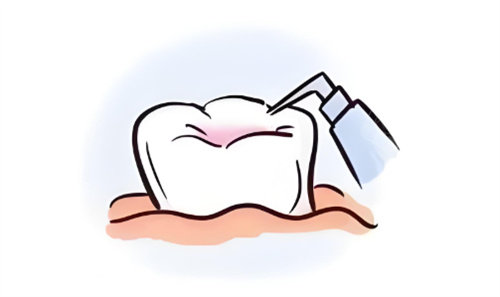 氟防龋材料怎么用窝沟封闭儿童有必要做吗？省钱防蛀vs材料脱落，家长正反意见大碰撞必看_https://www.jmylbn.com_新闻资讯_第1张