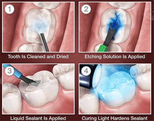 氟防龋材料怎么用窝沟封闭儿童有必要做吗？省钱防蛀vs材料脱落，家长正反意见大碰撞必看_https://www.jmylbn.com_新闻资讯_第4张