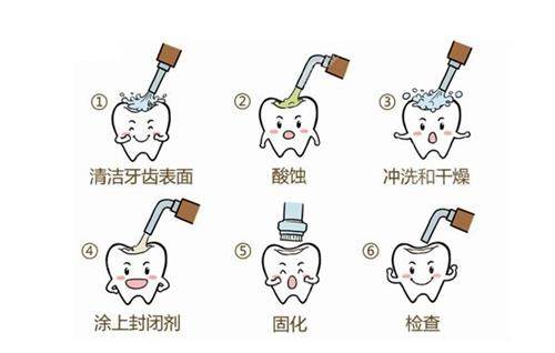 氟防龋材料怎么用窝沟封闭儿童有必要做吗？省钱防蛀vs材料脱落，家长正反意见大碰撞必看_https://www.jmylbn.com_新闻资讯_第2张