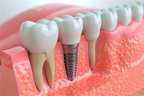 种植牙与正常牙齿模型对比漫画图